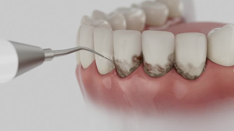 Trusted Wisdom Tooth Removal service in Claysburg, PA - Dentist Open Now